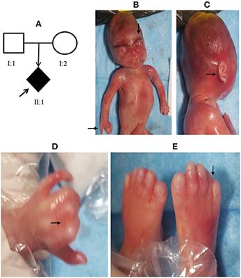 Case Report: Novel NIPBL Variants Cause Cornelia de Lange Syndrome in Chinese Patients